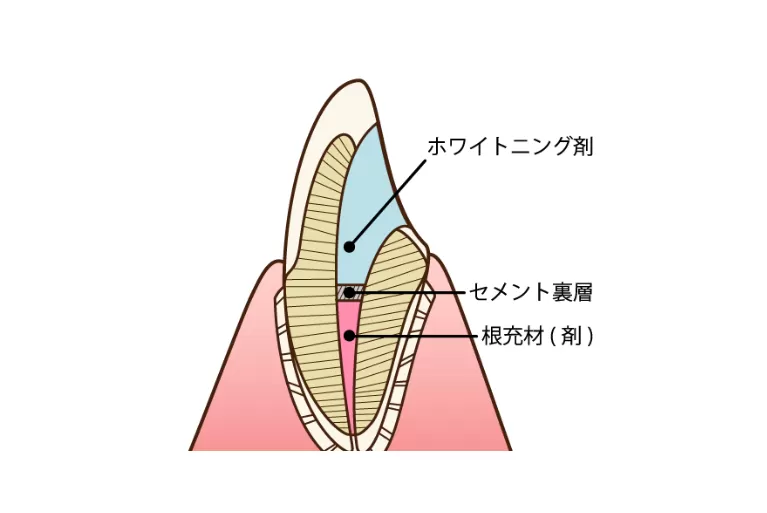 ウォーキングブリーチ
