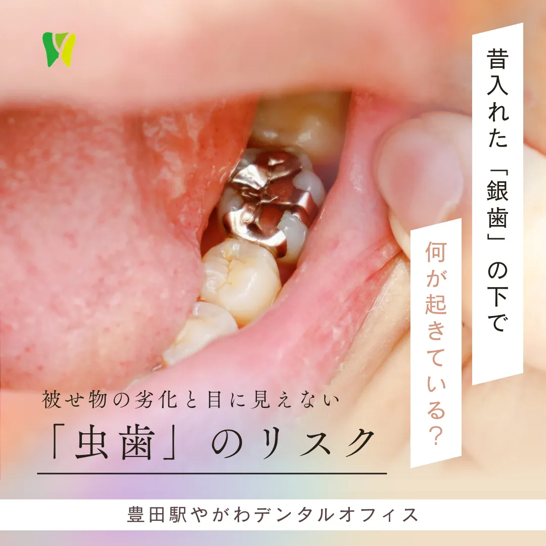 【20260515】昔入れた「銀歯」の下で何が起きている?被せ物の劣化と目に見えない虫歯のリスク