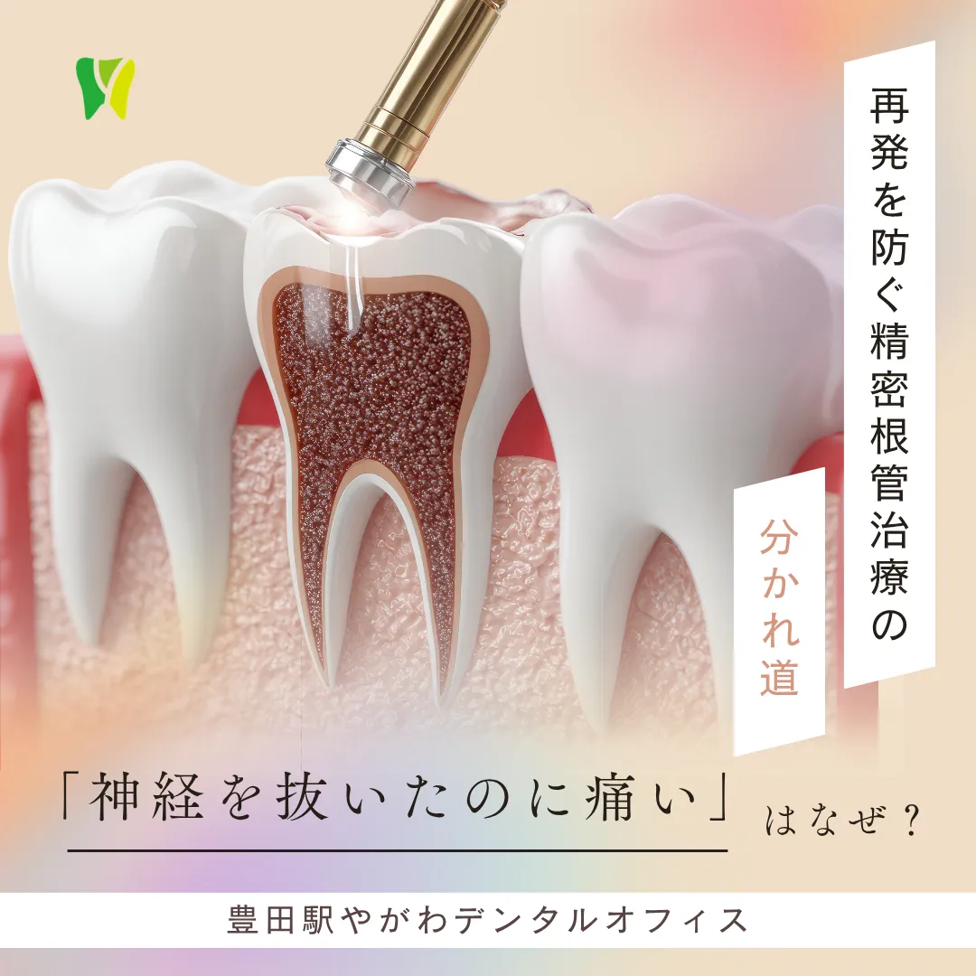 【20260417】「神経を抜いたのに痛い」はなぜ?再発を防ぐ精密根管治療の分かれ道